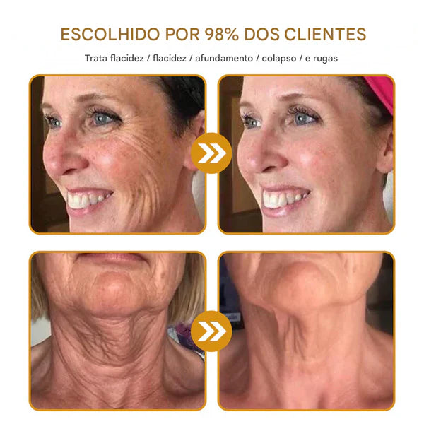 Creme removedor de rugas Botox Bee Venom - 🐝 Promoção relâmpago: só hoje!